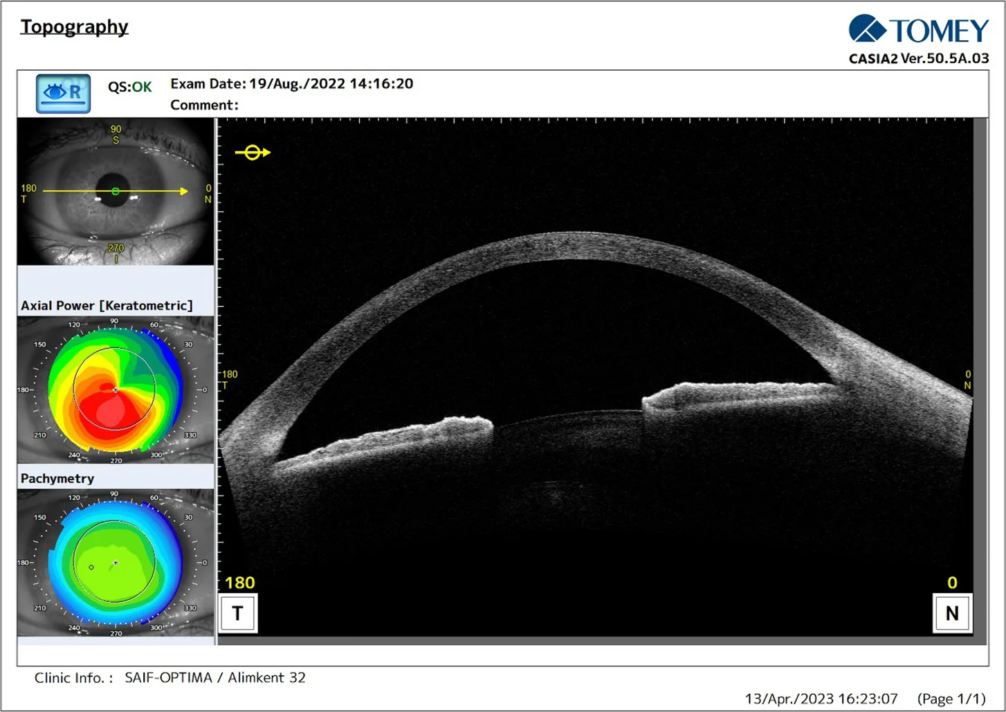 CASIA2 scores 2 months after Epi-Off corneal ACXL