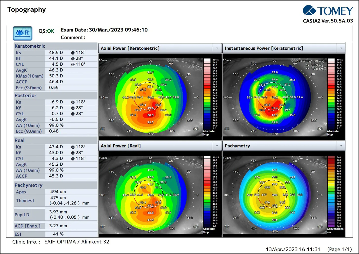 CASIA2 scores 9 months after Epi-Off corneal ACXL