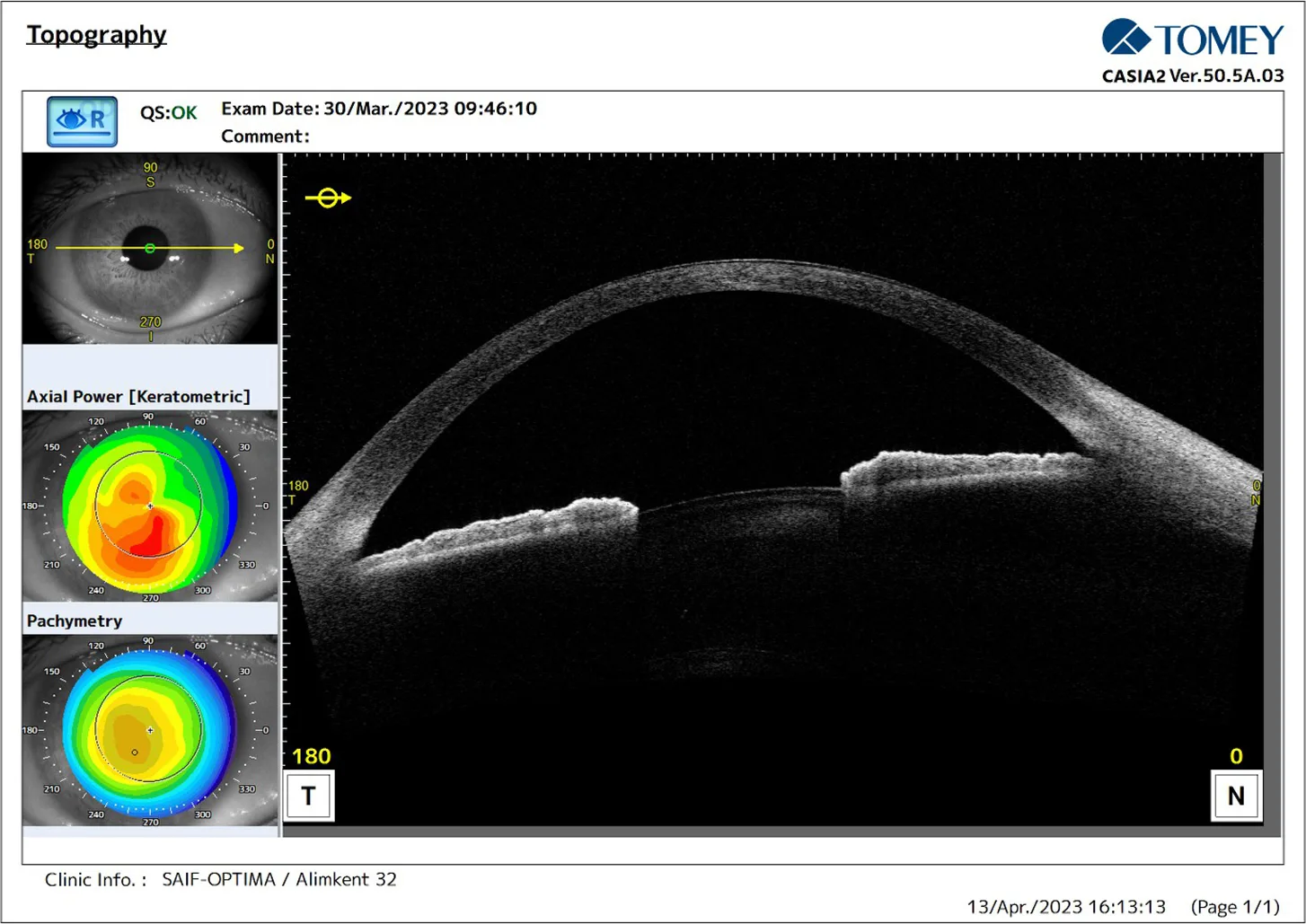 CASIA2 scores 9 months after Epi-Off corneal ACXL