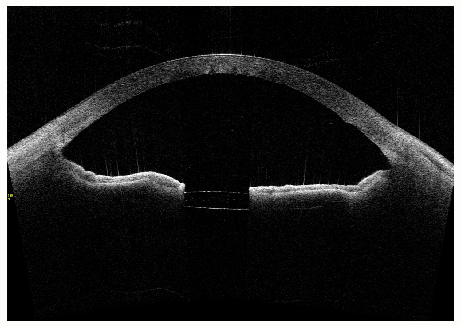 Postoperative Angle Closure After Pars-Plana Vitrectomy in Pseudophakic Eye