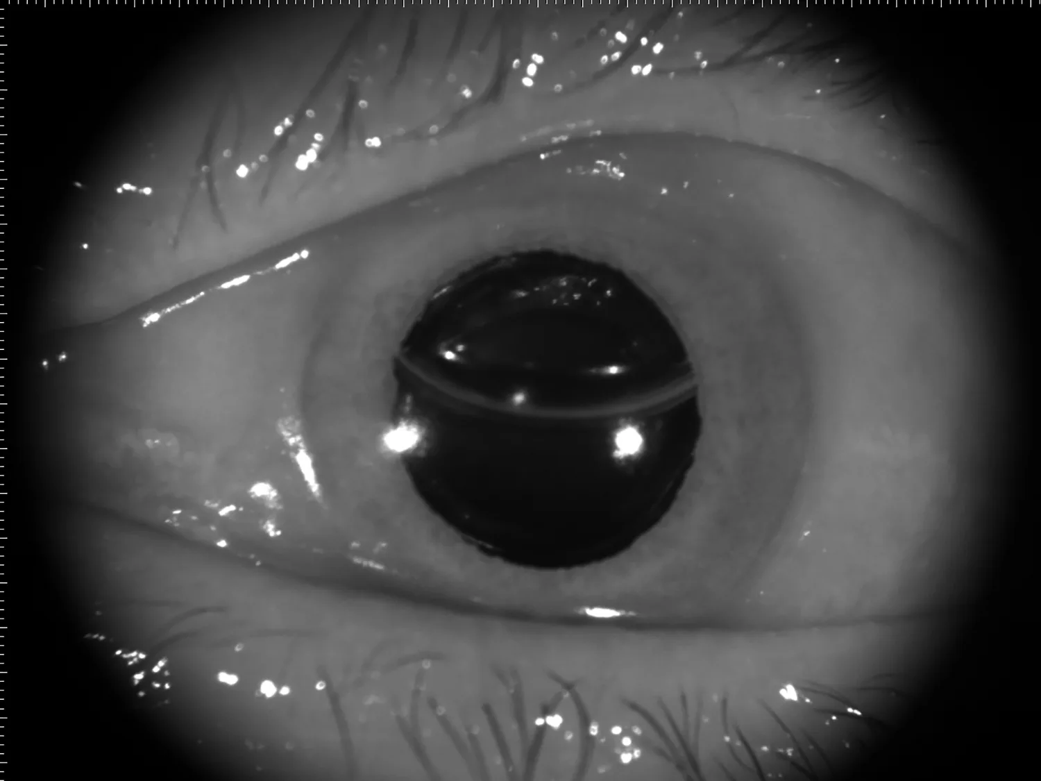 Gas bubble in the posterior chamber