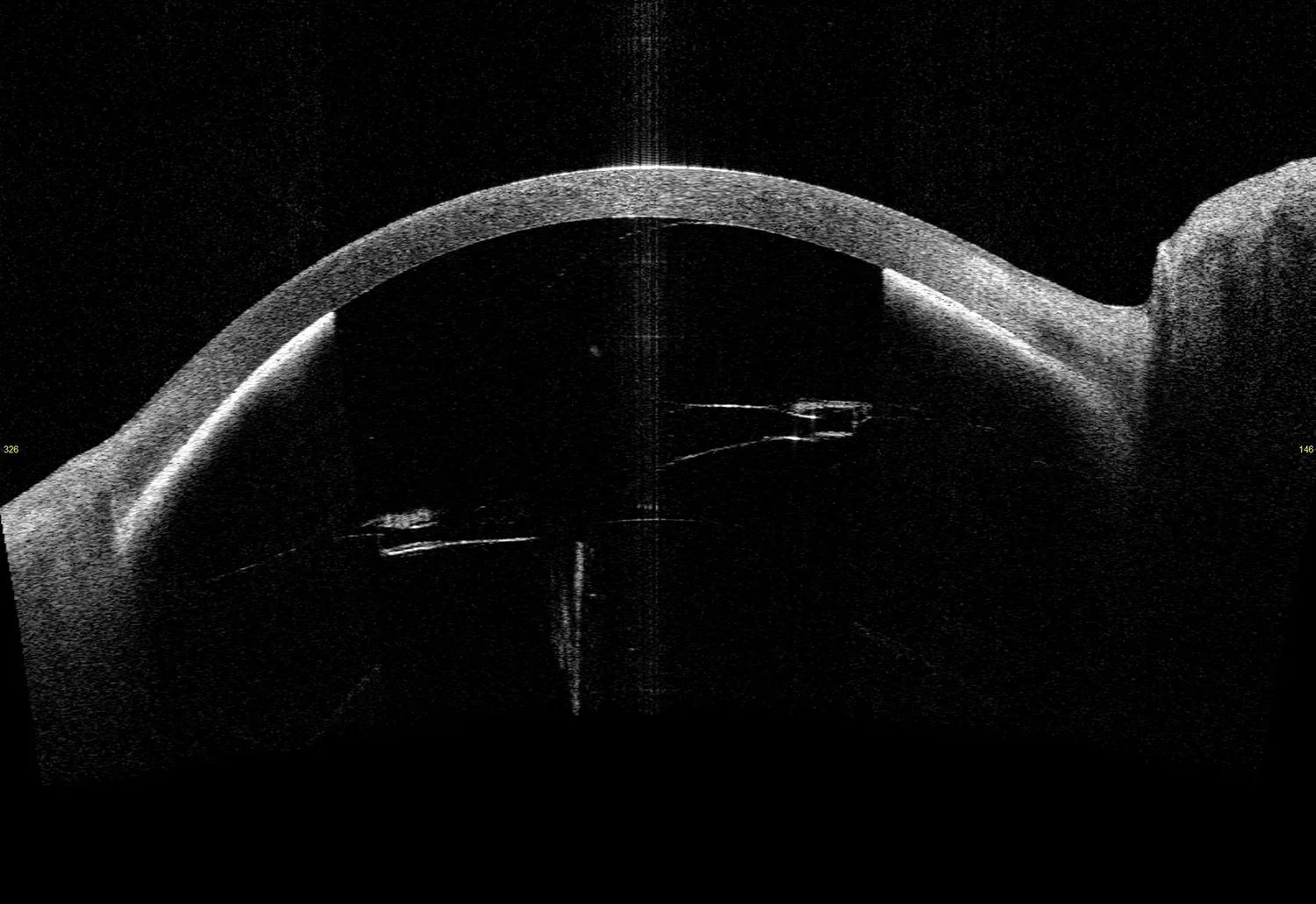 Gas bubble in the posterior chamber