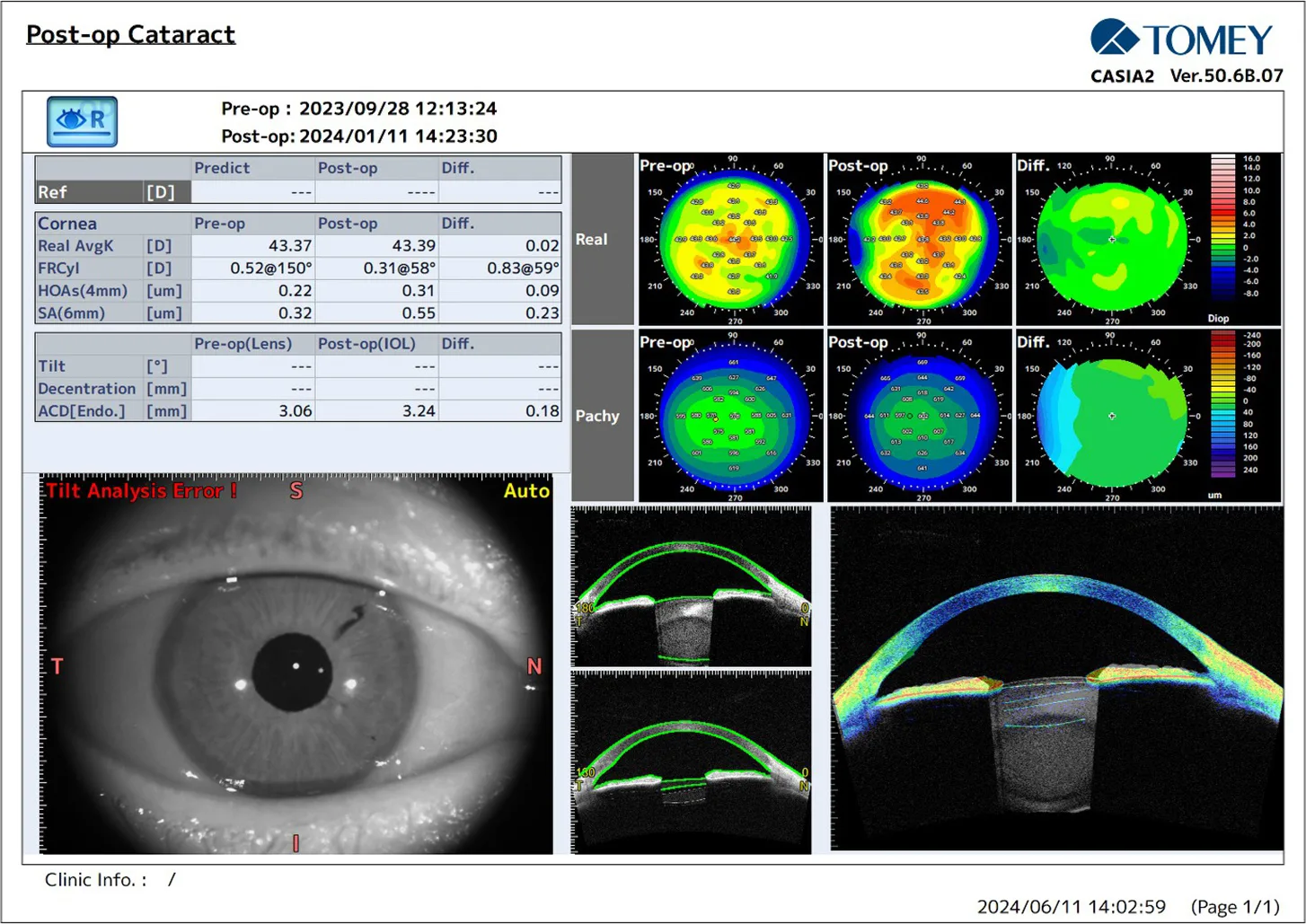 CASIA2 for Measuring the Ciliary Sulcus in Order to Determine the Size of an Accommodating Intraocular Lens