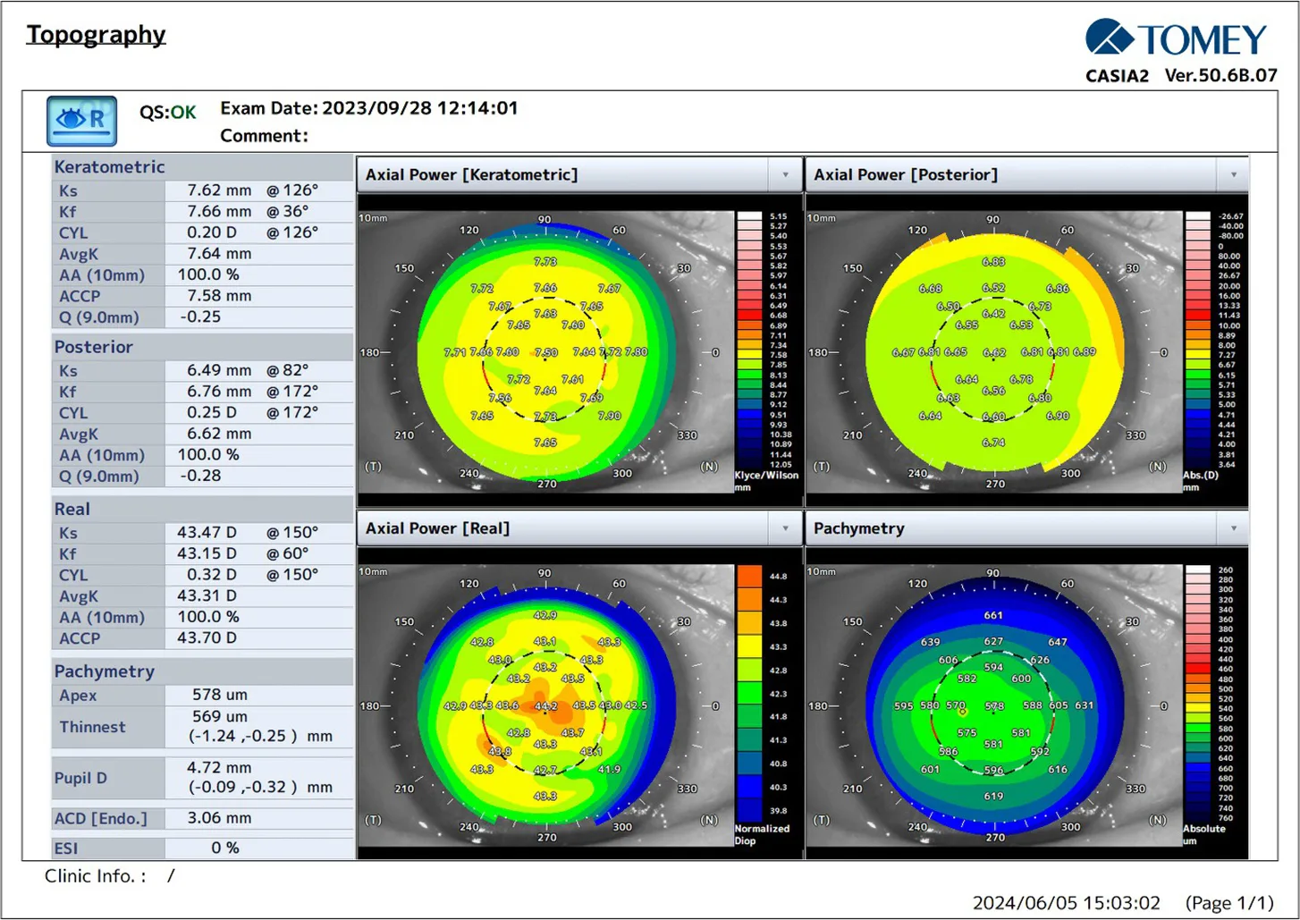 Preoperative topography