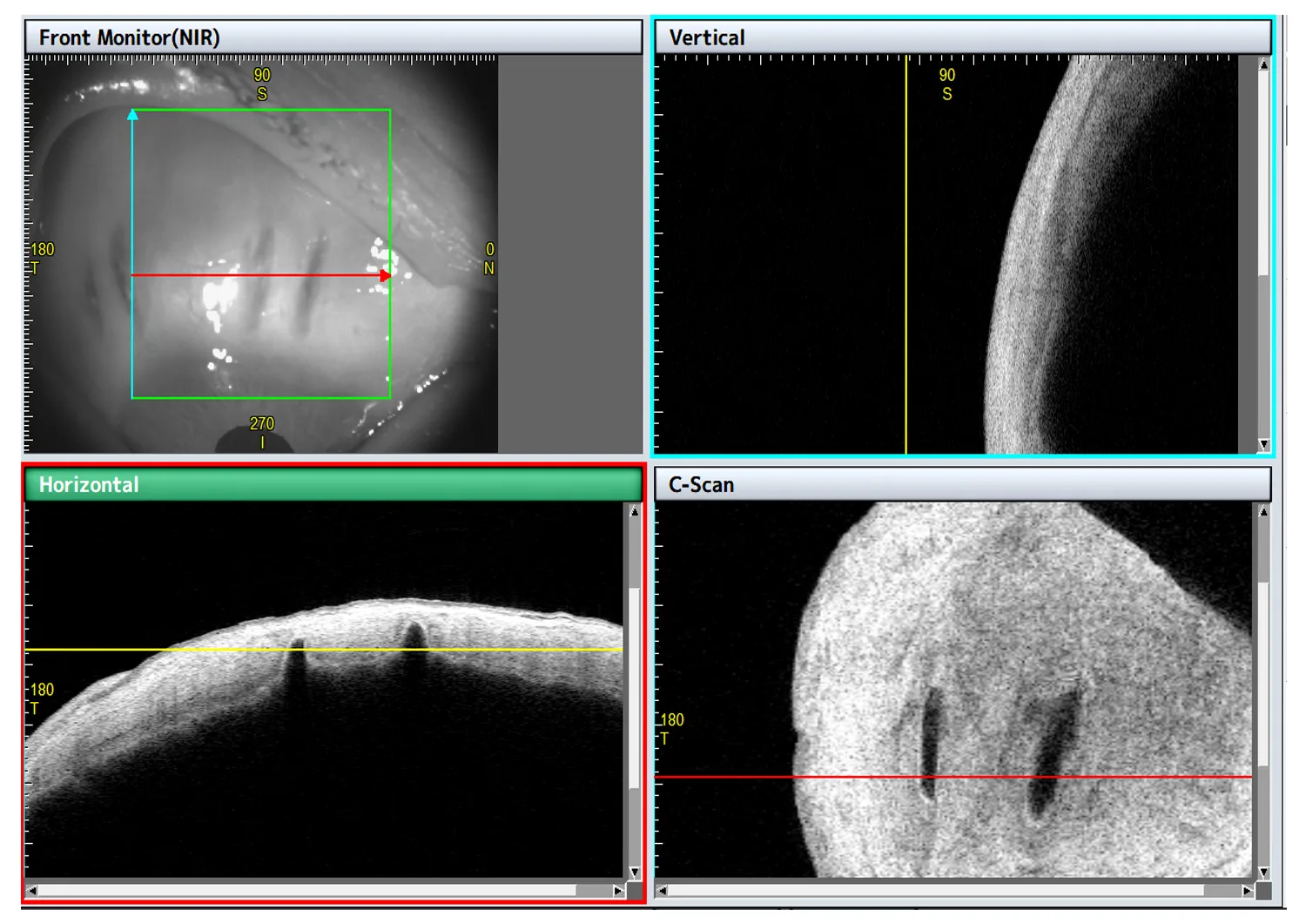 AS-OCT CASIA2 image