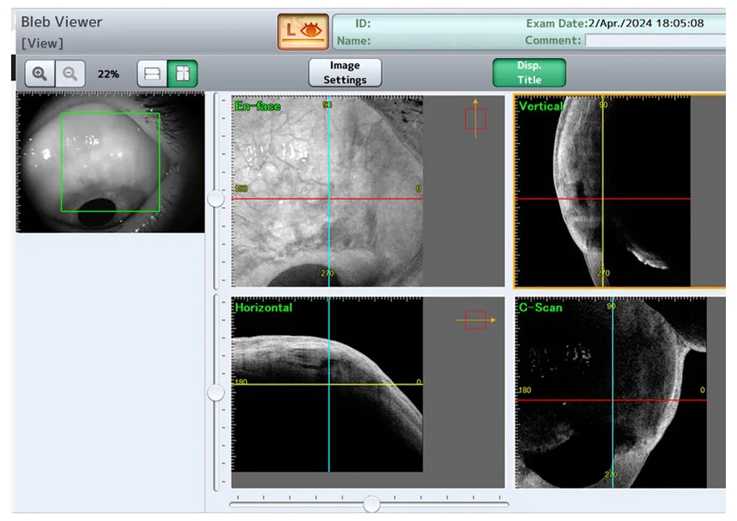 ESNOPER V2000 Implant