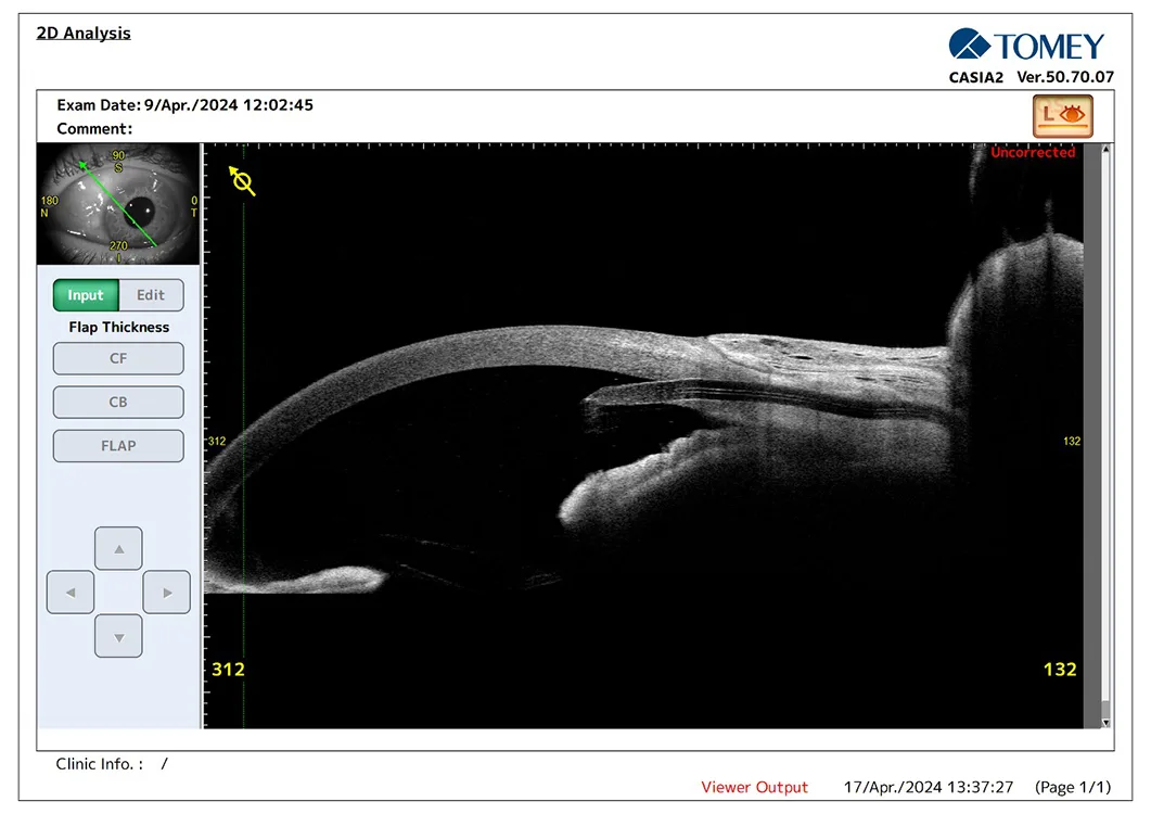 Preserflo® Implant