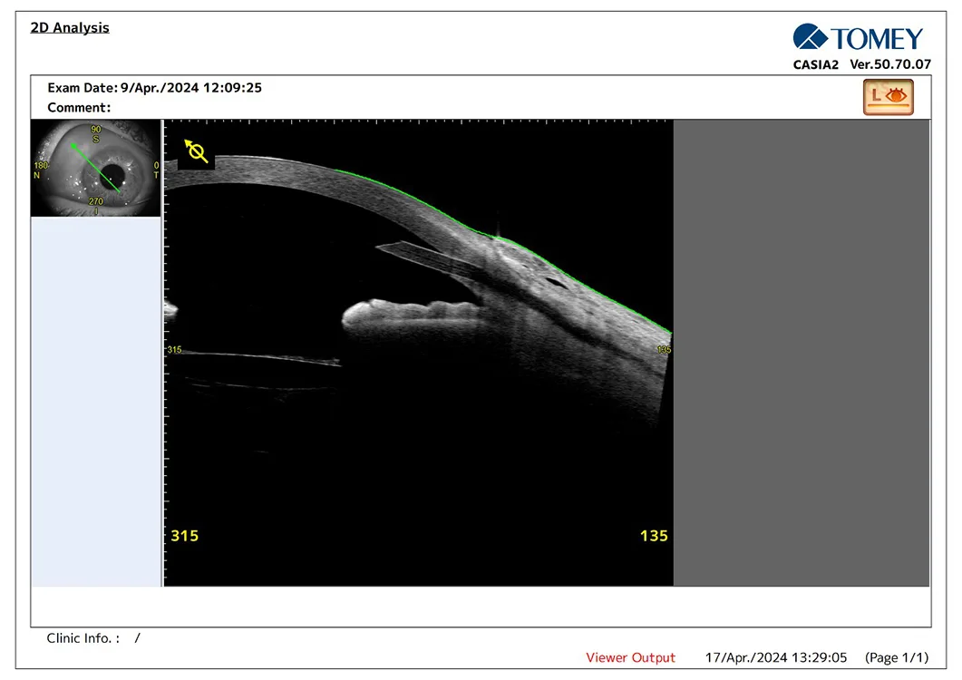 Preserflo® Implant