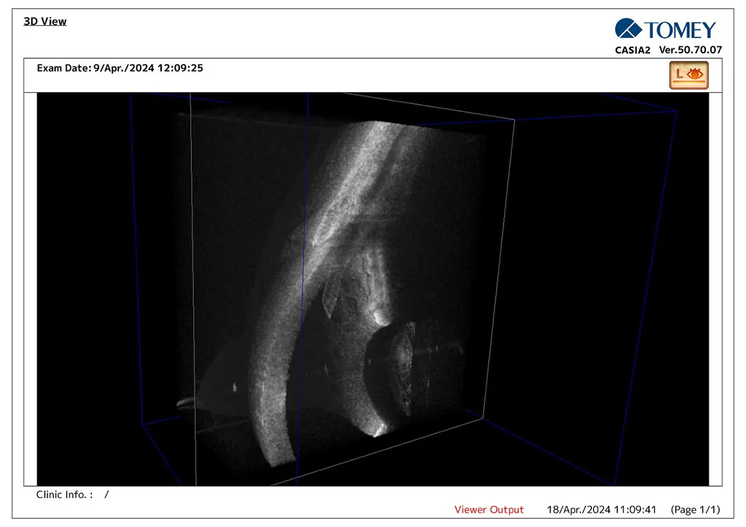 Preserflo® Implant
