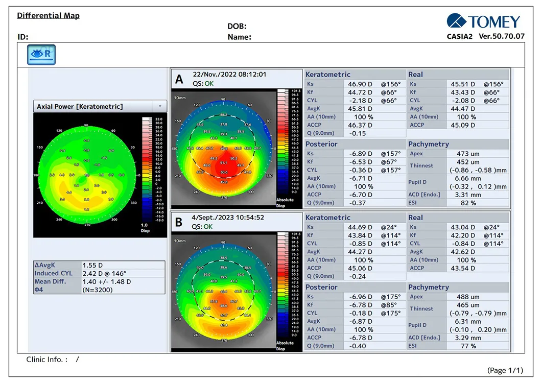 Asymmetric Ring Implantation in Keratoconus