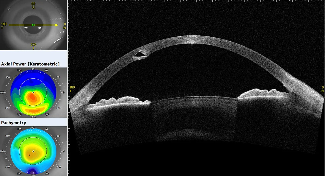 Asymmetric Ring Implantation in Keratoconus