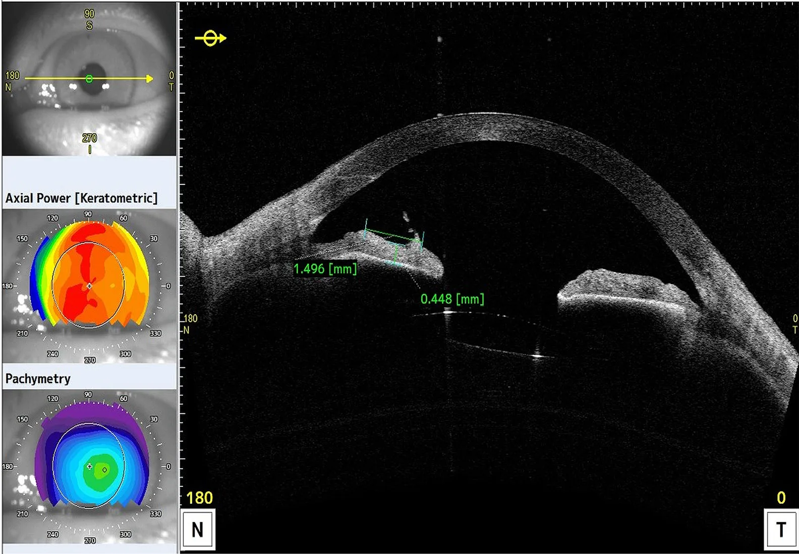 Figure 5: AS-OCT visualising the postoperative defect