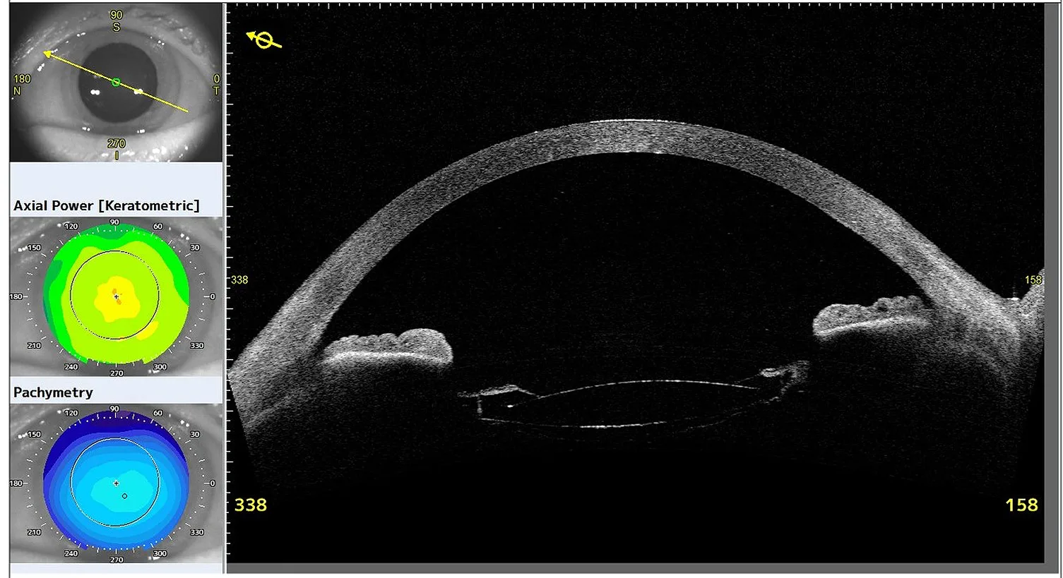 Figure 3: Day 7 assessment with a resolved membrane