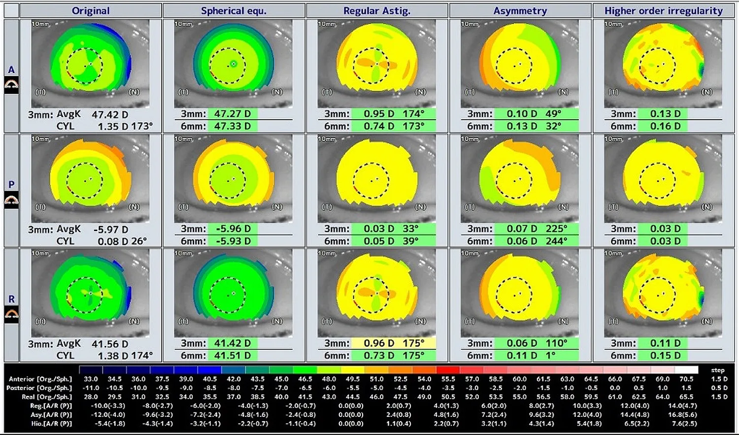 Preoperative assessment of corneal astigmatism as well as the phakic IOL