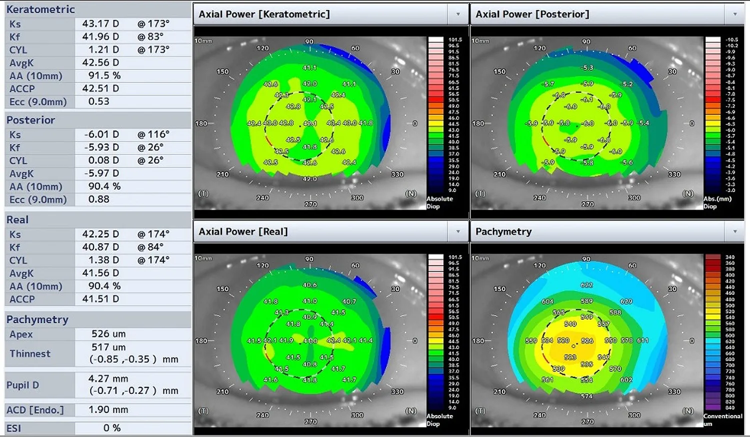 Preoperative assessment of corneal astigmatism as well as the phakic IOL