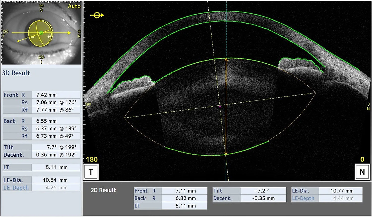 Preoperative assessment of corneal astigmatism as well as the phakic IOL