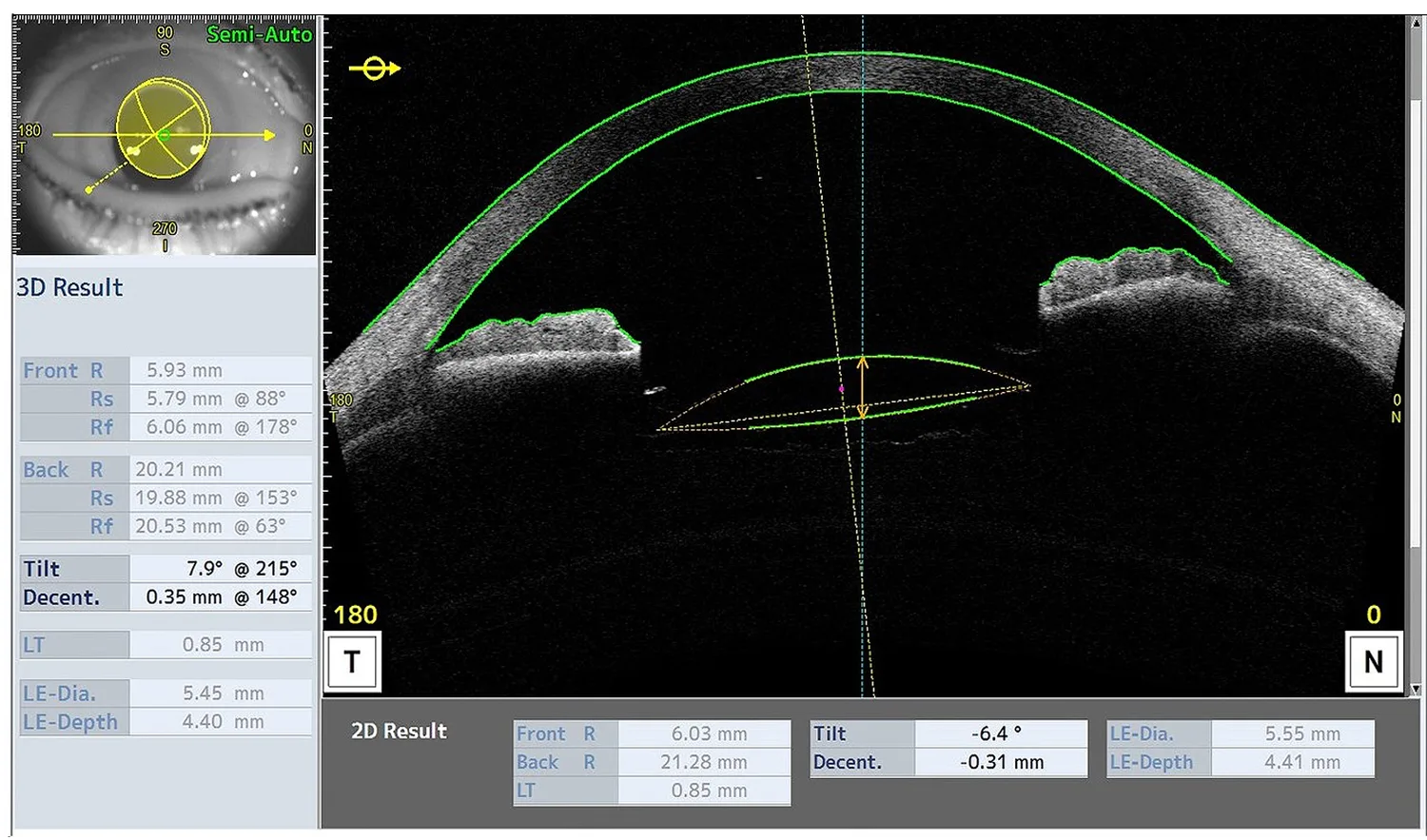Evaluation of the IOL 1 week after surgery before re-rotation
