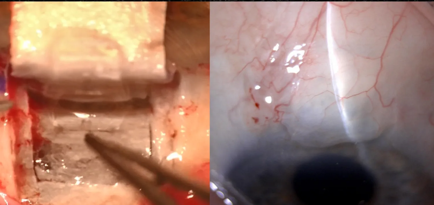 Intraoperative and anterior segment images
