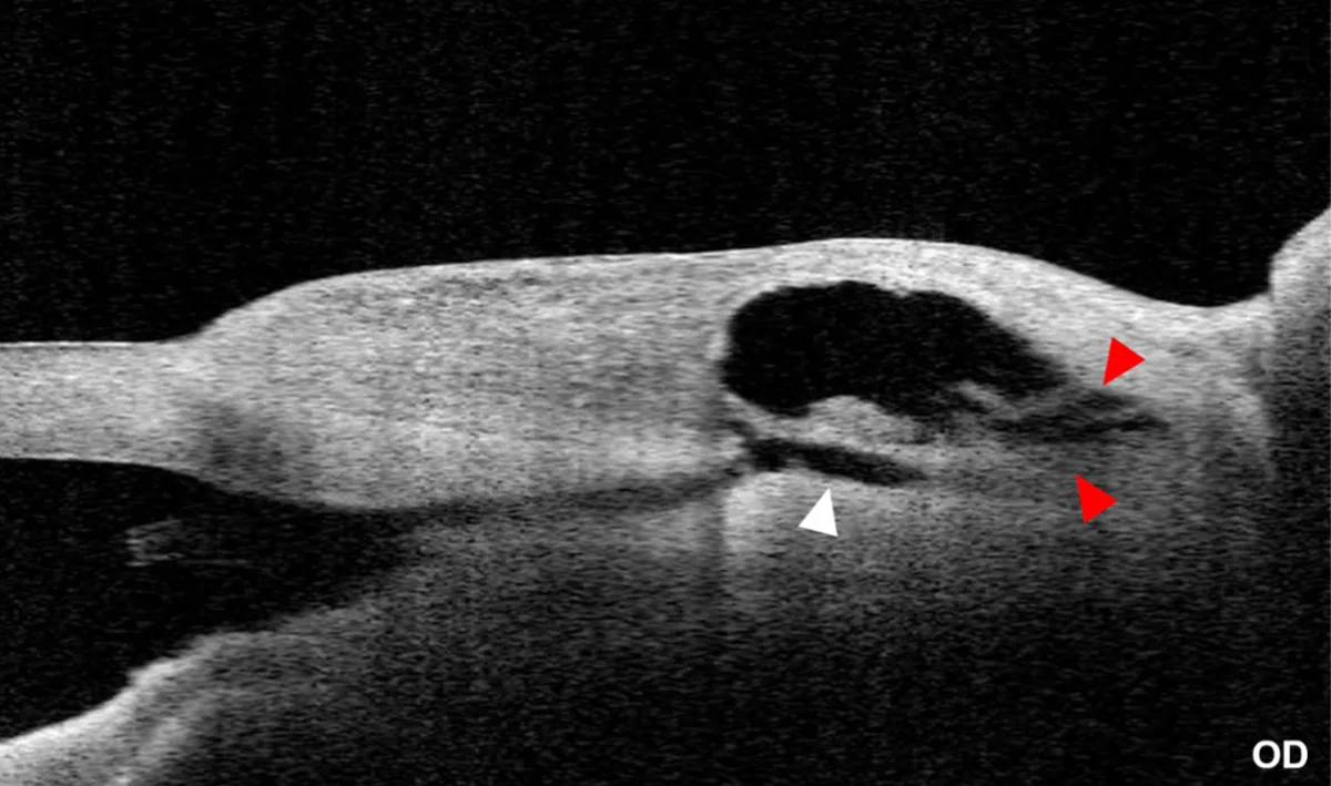 CASIA2 cross-sectional image using “bleb” mode