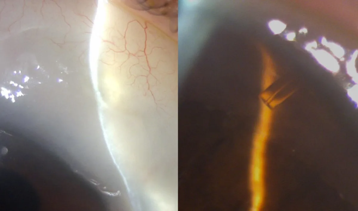 Anterior segment images