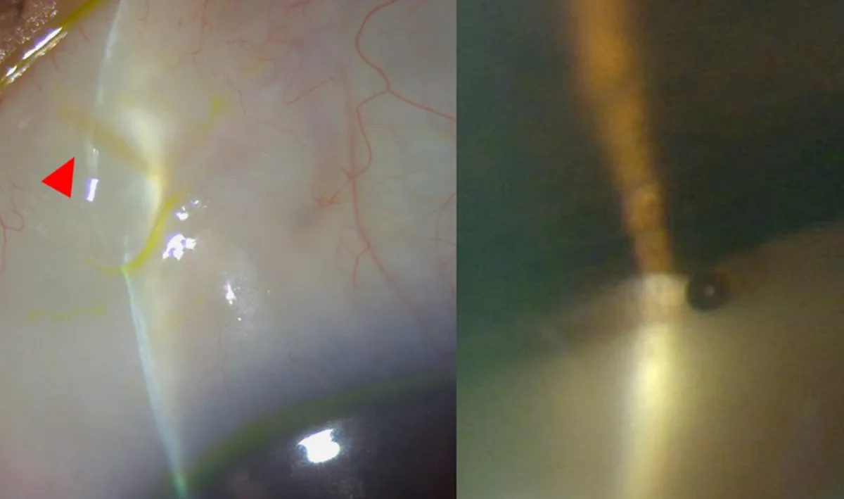 Anterior segment images