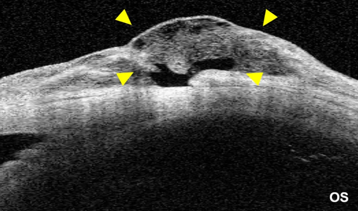CASIA2 cross-sectional image using “bleb” mode