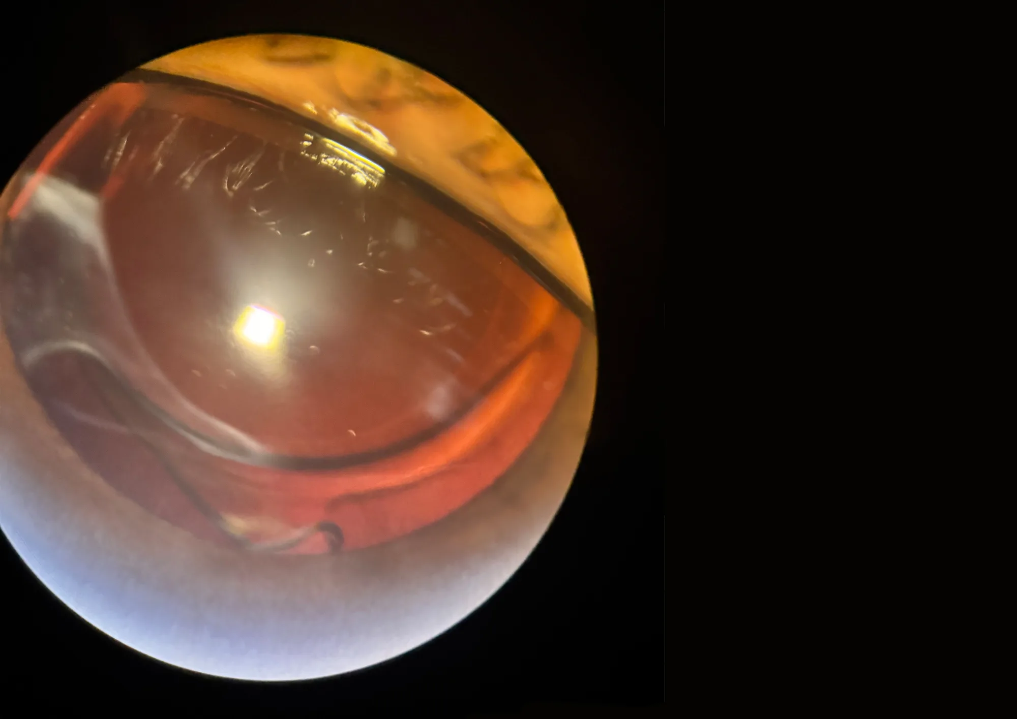 Figure 1: Intraoperative microscopic image demonstrating the configuration of two intraocular lenses positioned within the capsular bag during dual IOL implantation.
