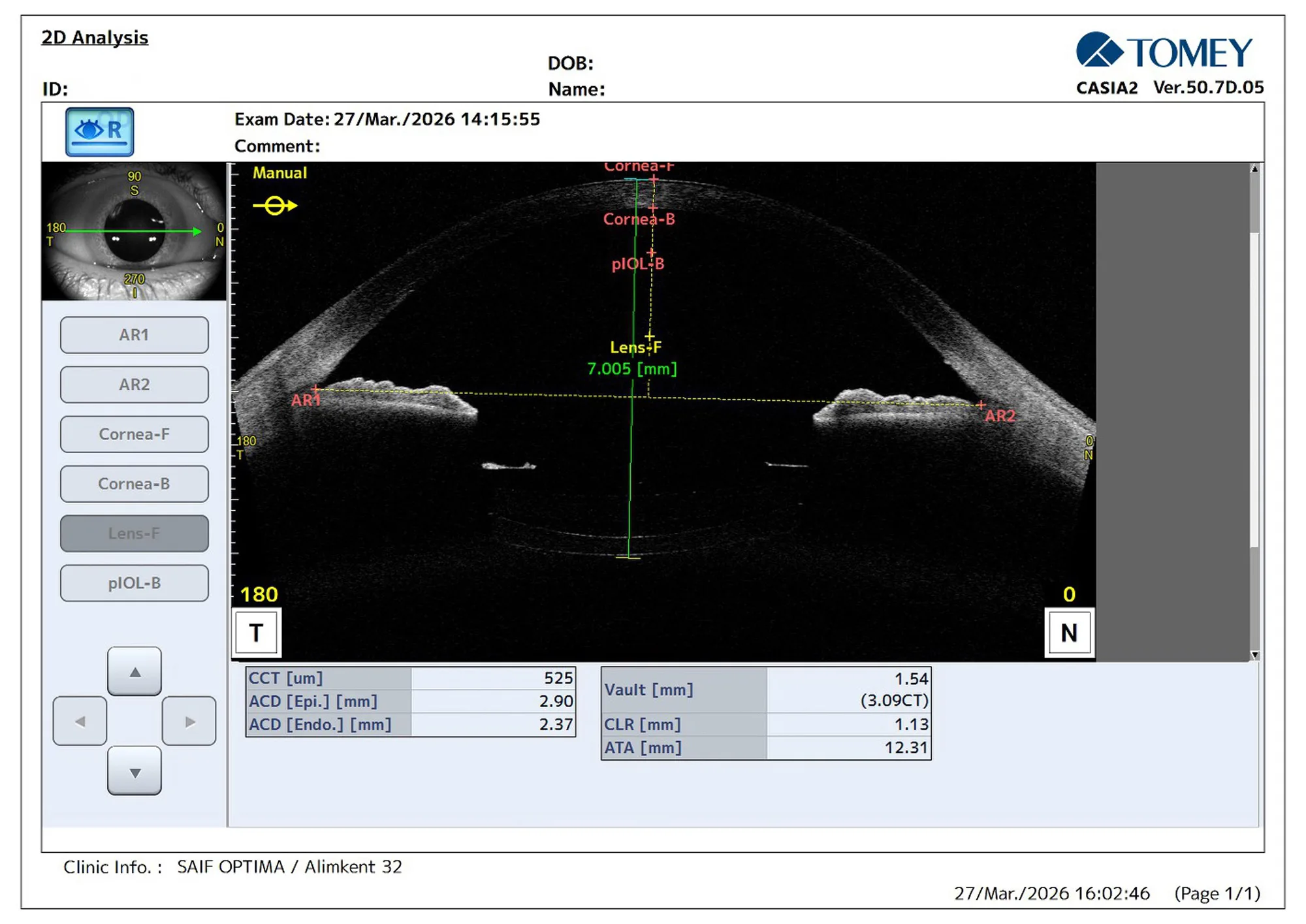 Figure 2: Anterior segment OCT image obtained with CASIA2 demonstrating the position of dual intraocular lenses within the capsular bag and measurement of the distance from the cornea to the posterior capsule.