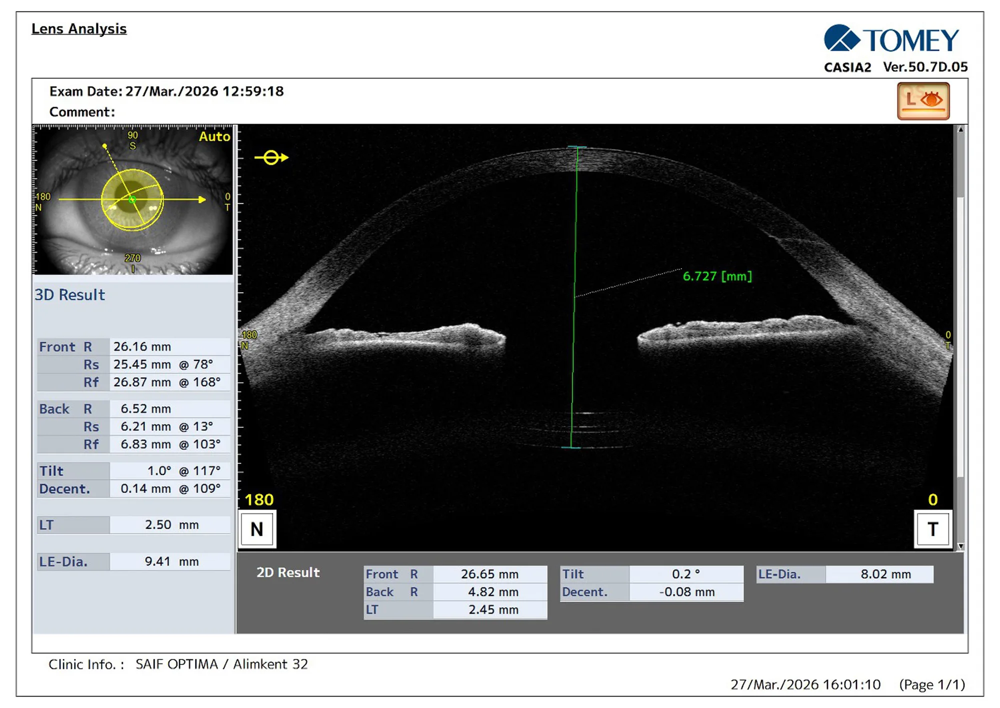 Figure 3: CASIA2 anterior segment OCT lens analysis demonstrating the configuration, centration, and spatial position of dual intraocular lenses within the capsular bag.