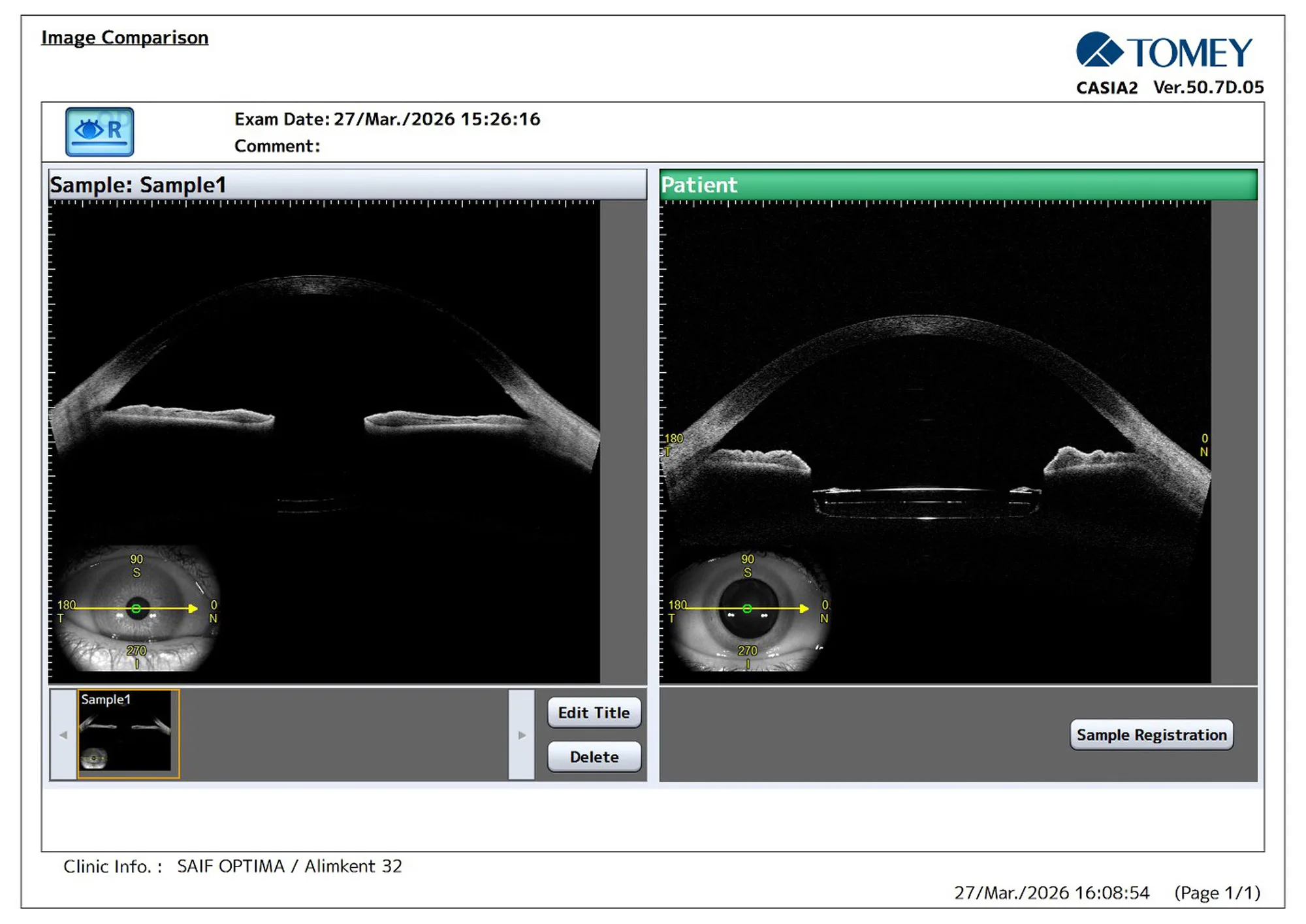 Figure 4: Comparison of anterior segment OCT images obtained with CASIA2 demonstrating the anatomical configuration of the anterior segment and the position of the intraocular lens complex.
